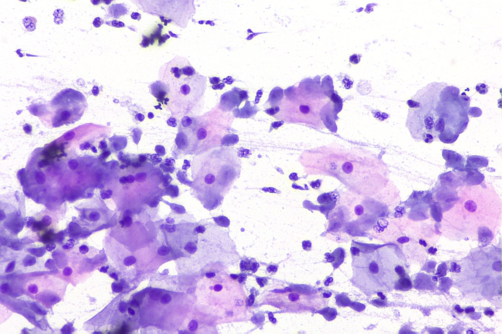 Micrografia real de citologia com Trichomonas vaginalis agrupados ao redor de células escamosas